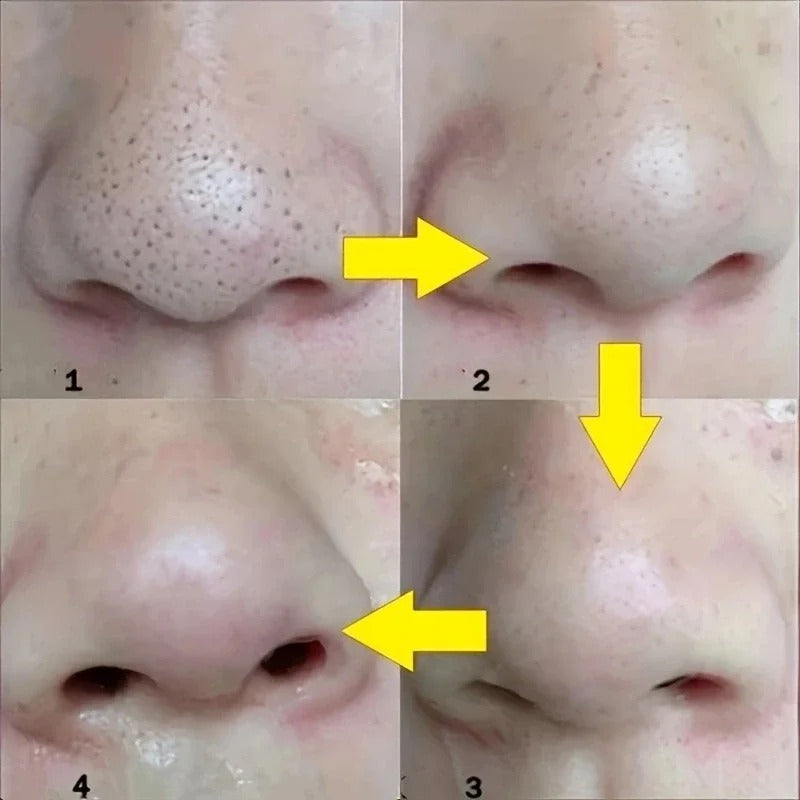 Deep Cleansing Pore Strips for Acne & Black Dots Treatment