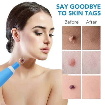 Painless Auto Skin Tag Remover