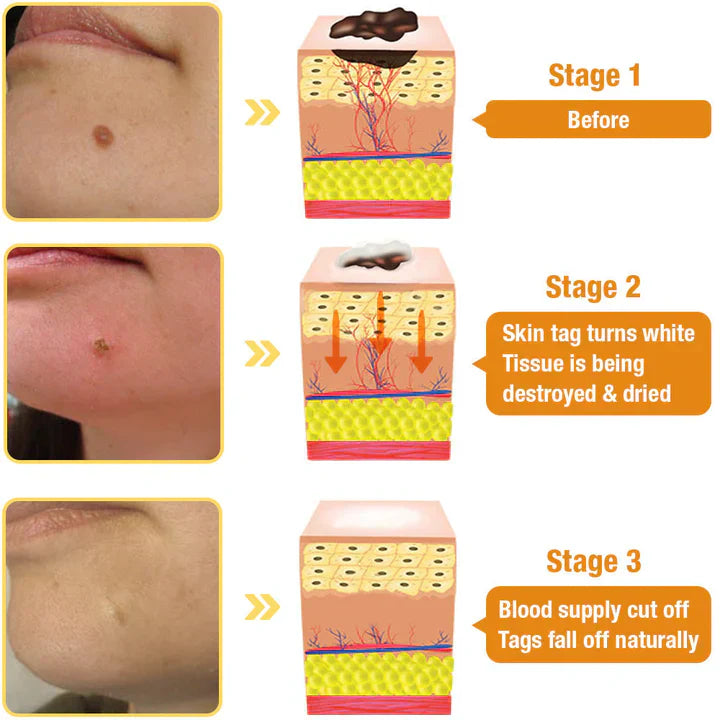 Bee Venom Treatment Spray - Skin Tag Removal - AVOXZY