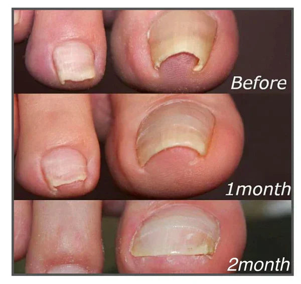 Correction Patches for Toenails - Ingrown Nail Treatment - AVOXZY