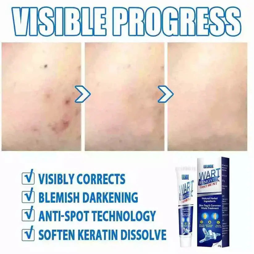 WartAway Herbal Removal Cream AVOXZY