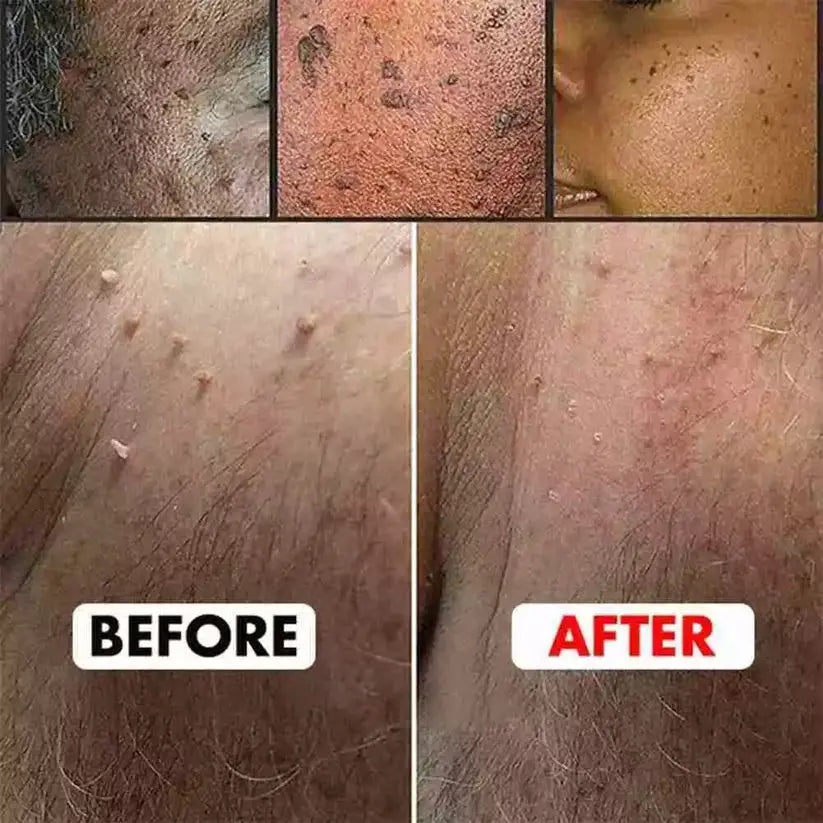 WartAway Herbal Removal Cream AVOXZY