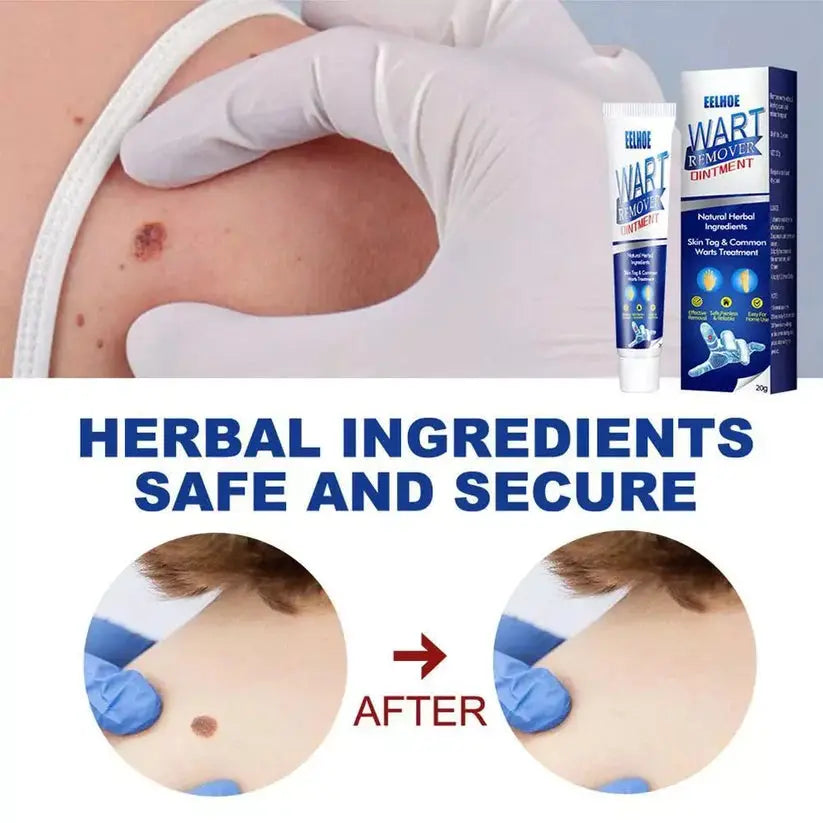 WartAway Herbal Removal Cream AVOXZY